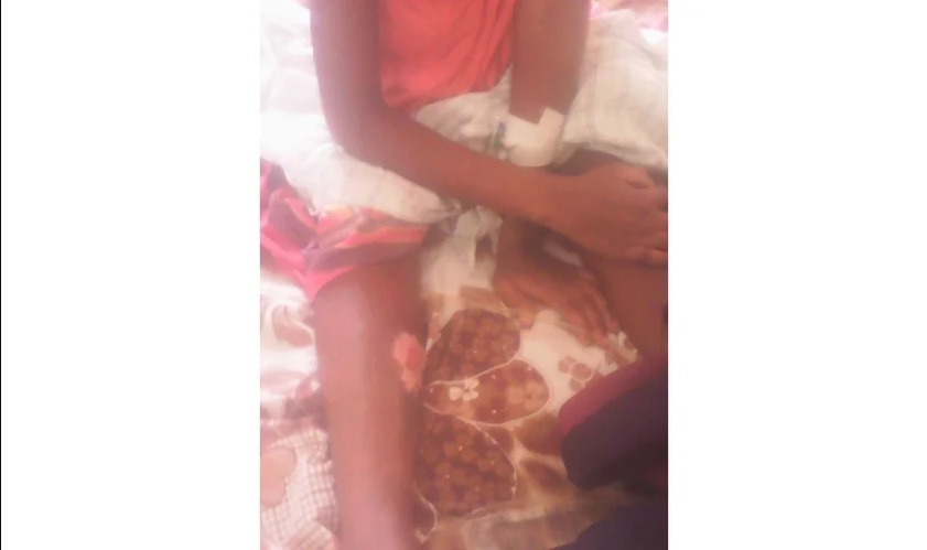 Some of the burns on 24-year-old Rehema Kyomuhendo, recovering in hospital in Mbale, Uganda. (Morning Star News)